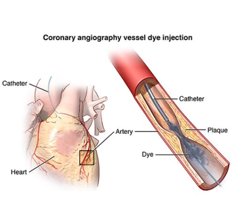 Coronary angiography showing catheter insertion and dye injection to detect plaque and blockage in heart arteries.