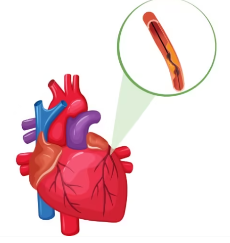 Illustration of human heart highlighting narrowed coronary artery indicating heart blockage detected during angiography test