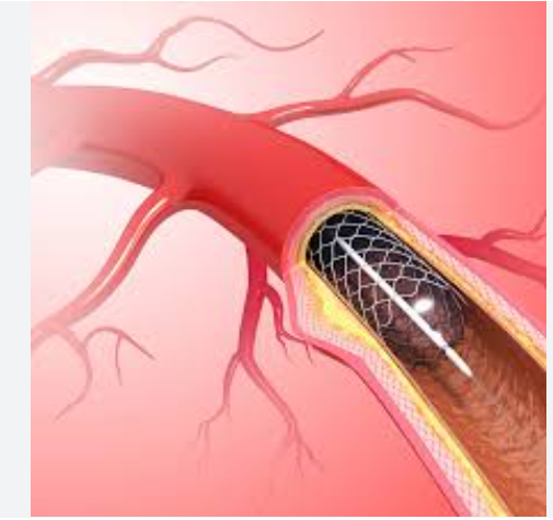 Illustration showing a heart artery blockage treated with a stent to restore blood flow