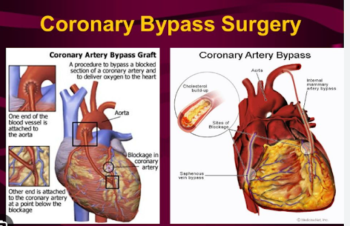 Diagram explaining coronary artery bypass grafting to restore blood flow around blocked arteries