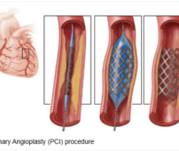 Step-by-step illustration of coronary angioplasty and stent placement procedure
