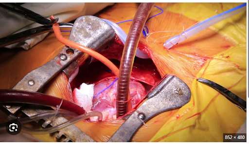 Open-heart bypass surgery showing graft placement during coronary artery bypass procedure