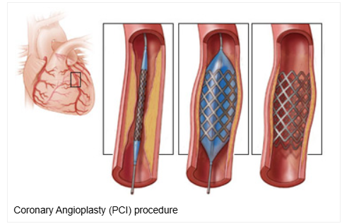 Step-by-step illustration of coronary angioplasty and stent placement procedure