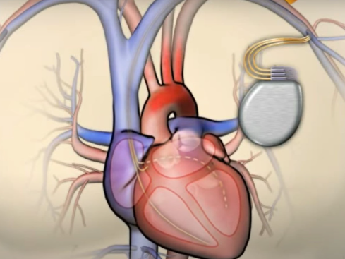 Medical diagram of a CRT-D device showing the pulse generator and leads placed in the heart chambers