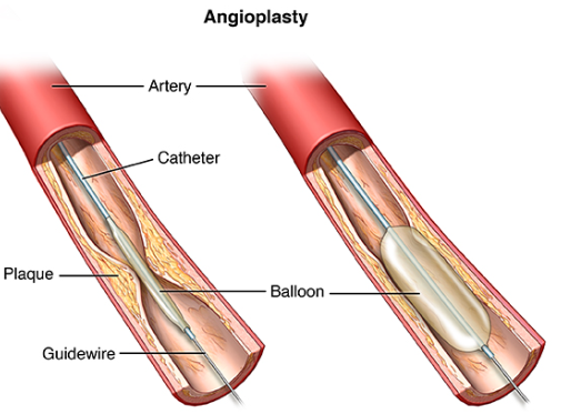 Medical diagram explaining pacemaker leads placed in heart chambers