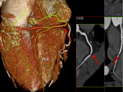 Coronary imaging of the LAD artery showing heart vessel analysis with arrow indicators for diagnosis