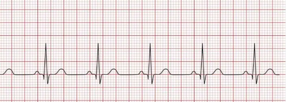 Patient lying down with chest electrodes as a clinician holds an ECG printout showing heart rhythm readings