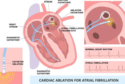 Illustration of electrophysiology catheter insertion from groin through vessels to the heart for rhythm testing