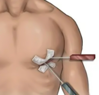Models showing access points for minimally invasive cardiac surgery versus open heart surgery