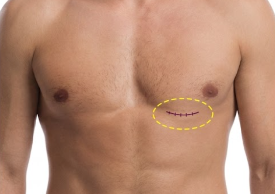 Comparison of surgical incision sites and access methods for various heart surgery procedures