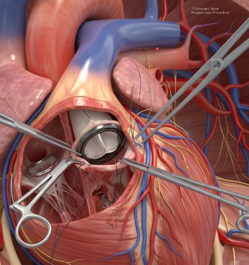 Medical illustration of heart valve replacement showing artificial valve and recovery concept after surgery